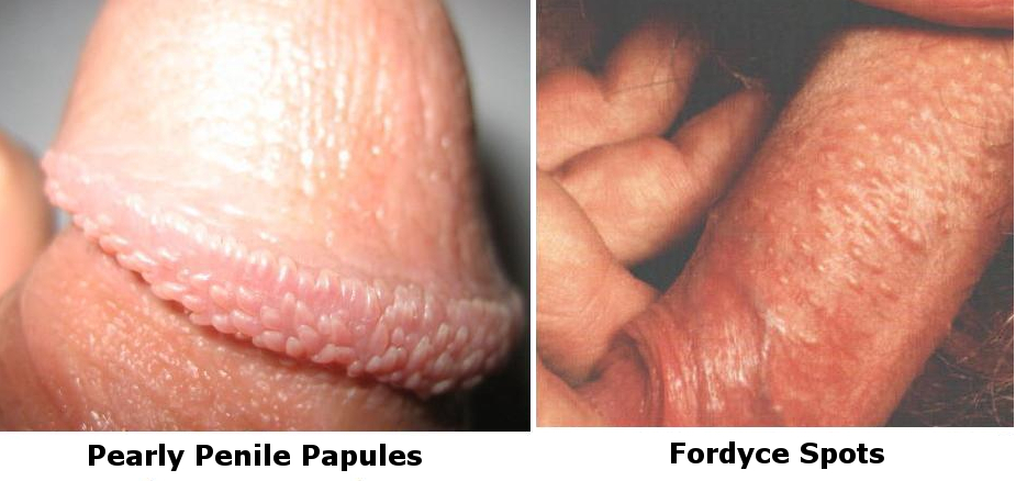 Fordyce Spots On Penis 99