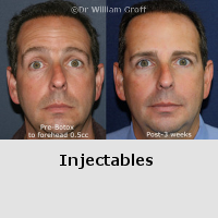Before and After Gallery - Injectables