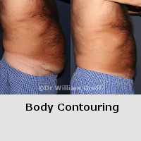 Before and After Gallery - Body Contouring