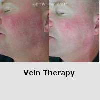 Before and After Gallery - Vein Therapy