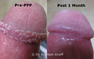 before and after photo of PPP treated patient