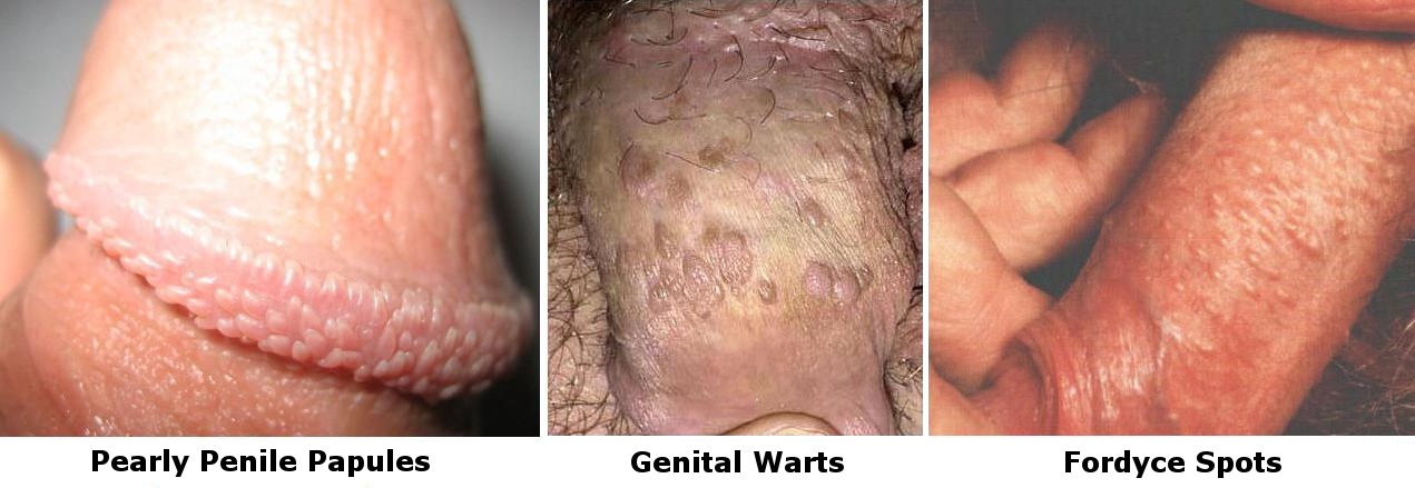 When Should Pearly Penile Papules Be Treated? 