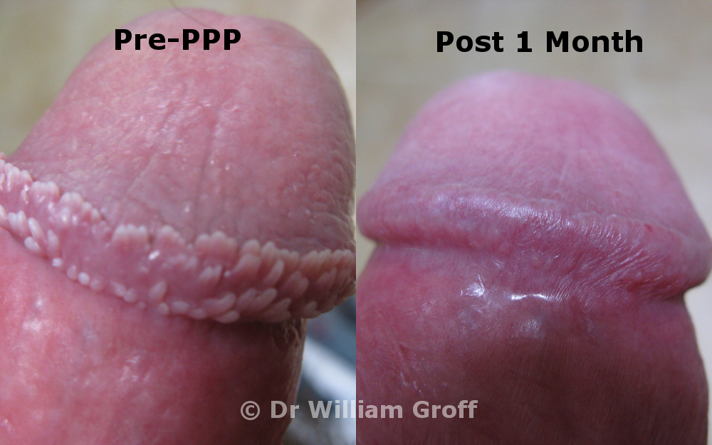 Dr. Groff has successfully treated over 2000 patients with pearly penile pa...