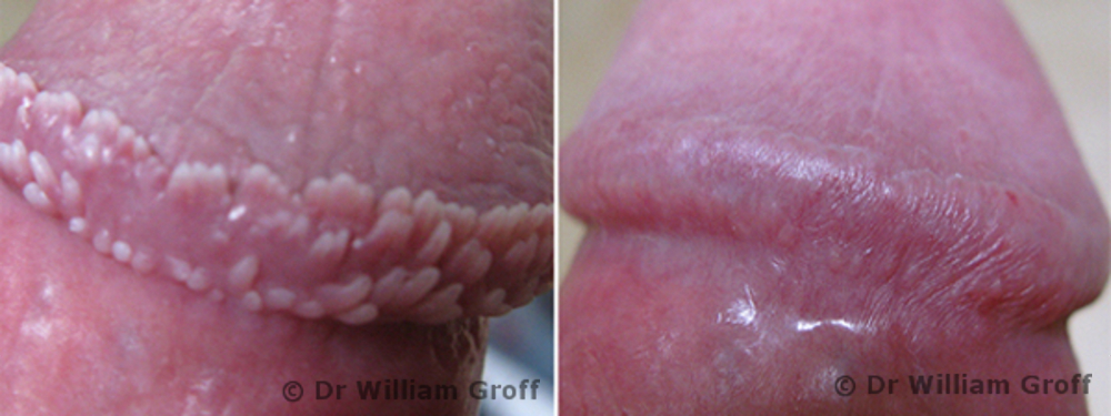 Dr. Groff has successfully treated over 2000 patients with pearly penile pa...
