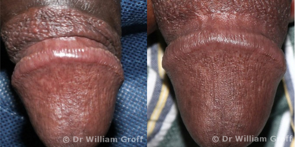 GALLERY - Pearly Penile Papules PPP